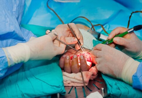 Microsurgery vs. Open Surgery in Neuroscience